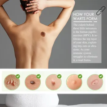 Ximonth Mole Remover Ointment