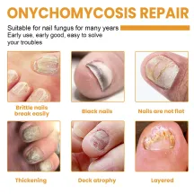 Ximonth Fungal Nail Patches 